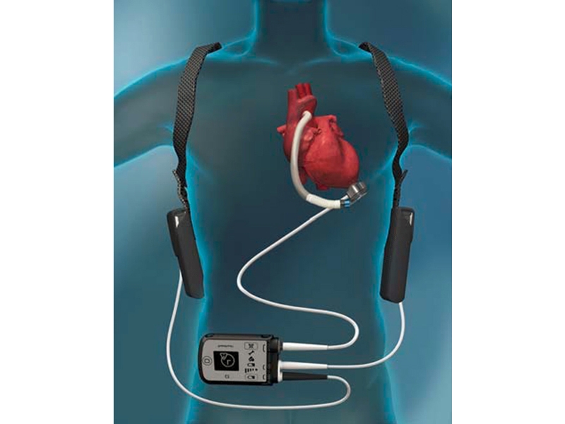 The LVAD